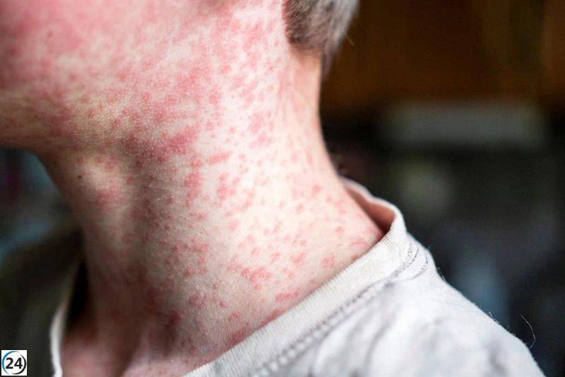 Aumentan a 22 los casos de sarampión en un brote laboral en Alicante.